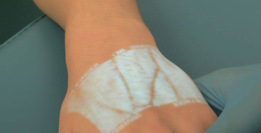 В больницу Муравленко поступили визуализаторы вен